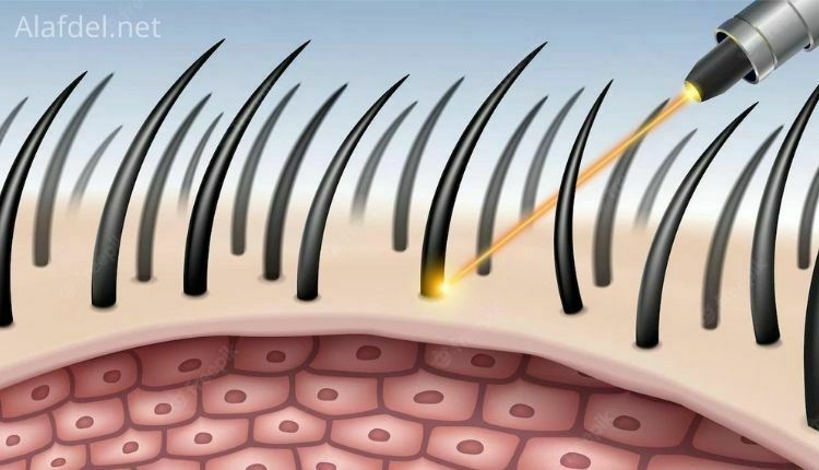 رسم يوضح شعاع من جهاز ليزر يصل إلى جذور الشعر وذلك ضمن طرق تقليل نمو شعر الوجه للنساء