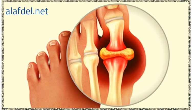 أعراض النقرس في الركبة Symptoms of gout in the knee 