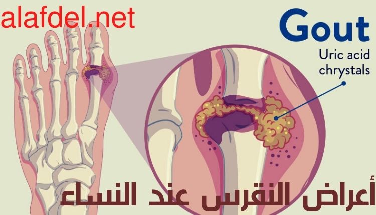 أعراض النقرس عند النساء Symptoms of gout in women تراكم البلورات حول المفصل