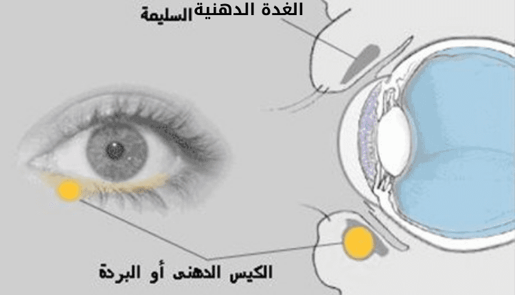 صورة بها رسم لعين الإنسان، ويوضح هذا الرسم أسباب الكيس الدهني في العين