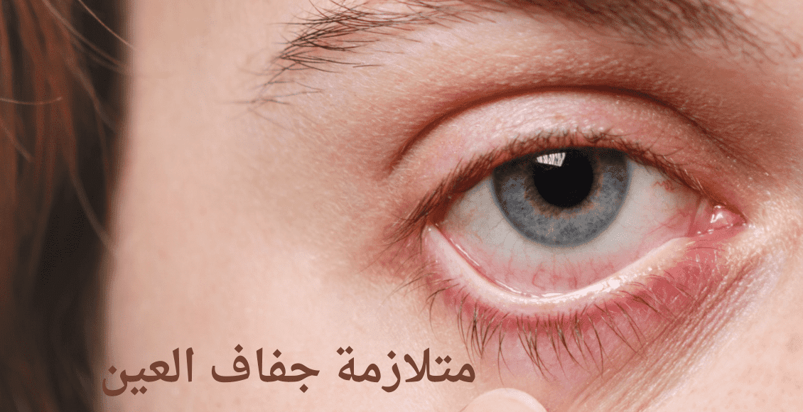 صورة توضح شكل متلازمة جفاف العين dry eye syndrome