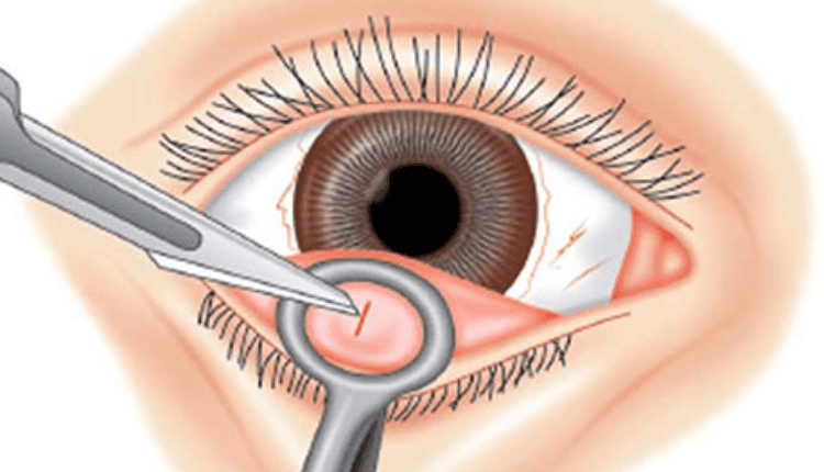 صورة بها عين بشرية يتم إجراء بها استئصال الكيس الدهني في العين