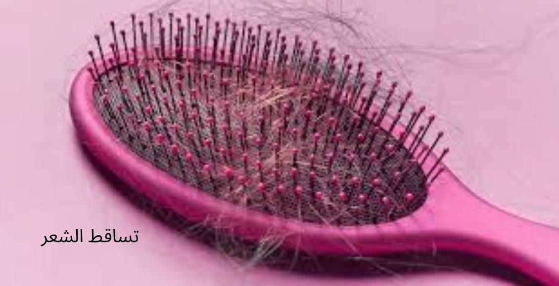 صوره تحتوى على فرشاة للشعر وبها الكثير من الشعر المتساقط تمثل تساقط الشعر hair loss