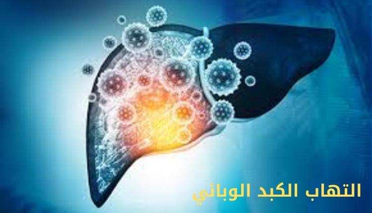 صورة تحتوى على كبد مصاب بمرض التهاب الكبد الوبائي hepatitis