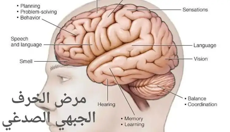 صورة بها رسم لدماغ ووجه الإنسان ومكتوب على الصورة مرض الخرف الجبهي الصدغي Frontotemporal dementia disease