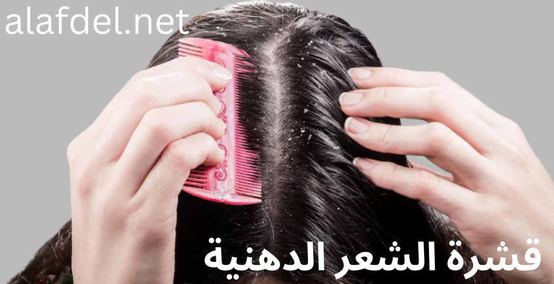 صورة مكتوب عليها قشرة الشعر الدهنية Oily hair dandruff، وتوضح فروة رأس سيدة تمشط شعرها بالمشط وتعاني من القشرة