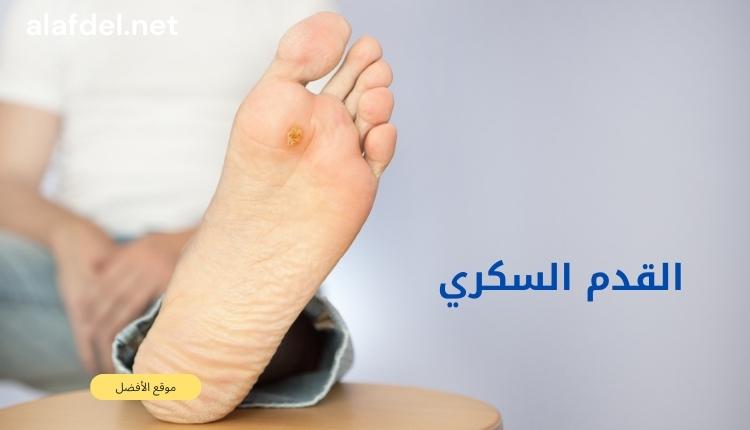 صورة بها شخص يعرض قدمه التي بها جرح وذلك ضمن الحديث عن القدم السكري diabetic foot