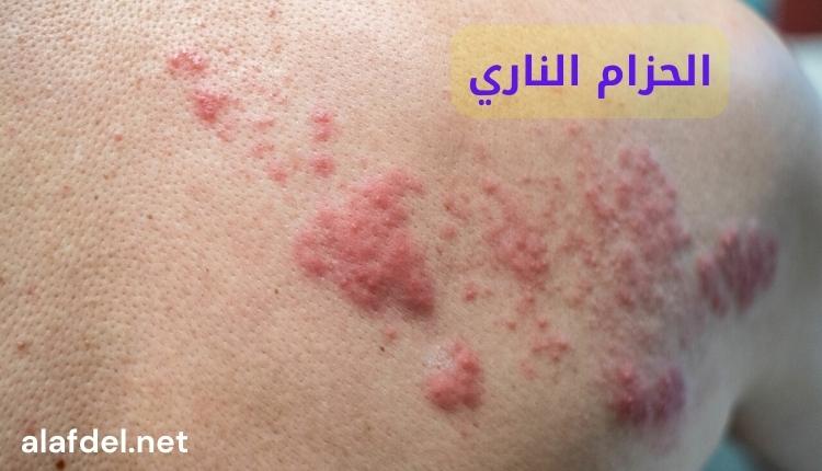 صورة بها شكل مرض الحزام الناري Shingles على جلد أحد الأشخاص