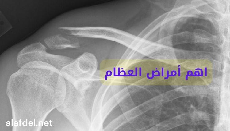 صورة بها أحد الأشعة التي تمت على العظام ضمن الحديث عن اهم أمراض العظام The main major bone diseases