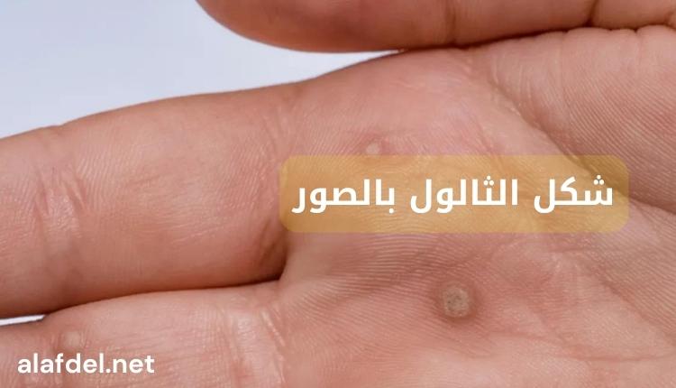 صورة بها يد إنسان مكتوب عليها شكل الثالول بالصور The shape of the Warts with pictures