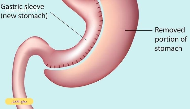 صورة بها رسم لمعدة إنسان وذلك ضمن الحديث عن أنواع عملية تكميم المعدة