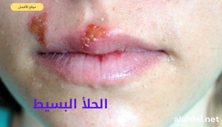 صورة يظهر بها جزء من وجه فتاة وذلك ضمن الحديث عن الحلأ البسيط herpes simplex