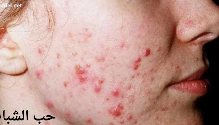 صورة يظهر بها جزء من وجه إنسان ضمن الحديث عن حب الشباب the-acne-vulgaris