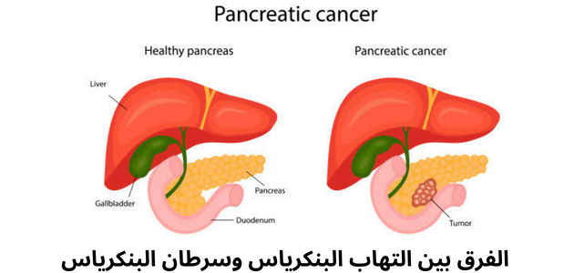 صورة توضح رسم لبنكرياس طبيعي وسرطان البنكرياس ضمن موضوع الفرق بين التهاب البنكرياس وسرطان البنكرياس