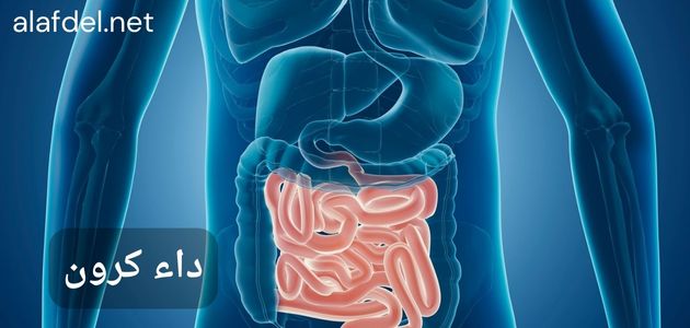 صورة بها رسم لجزء من جسم الإنسان وذلك ضمن الحديث عن داء كرون Crohn's disease