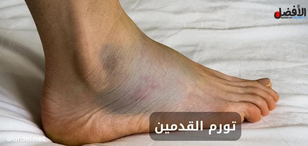 صورة يظهر قدم شخص شخص بها تورم ضمن الحديث عن تورم القدمين swollen feet