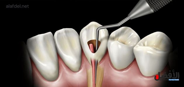 Endodontics with laser