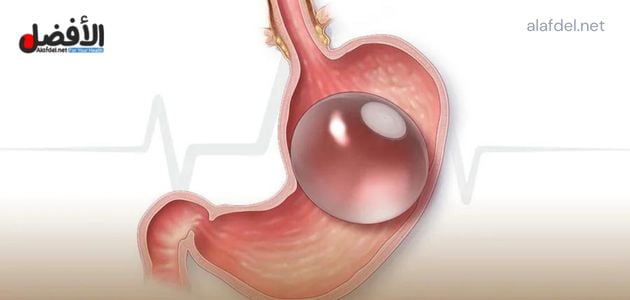 عملية بالون المعدة في تركيا