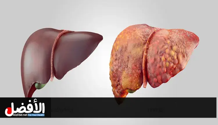 أسباب دهون الكبد وعلاقتها بمقاومة الإنسولين