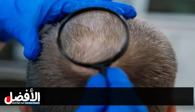 الفرق بين زراعة الشعر في تركيا وإيران