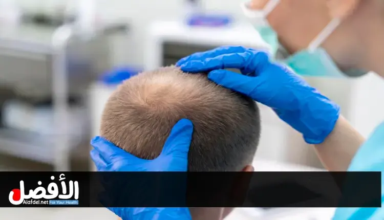 الفرق بين زراعة الشعر في تركيا وإيران