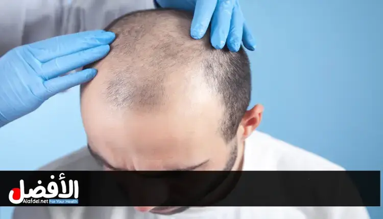 الفرق بين زراعة الشعر في تركيا وإيران