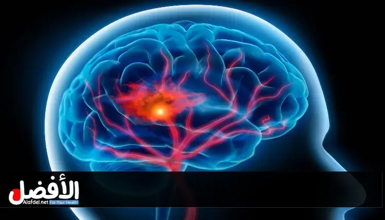 العوامل التي تحدد متى يموت مريض الجلطة الدماغية