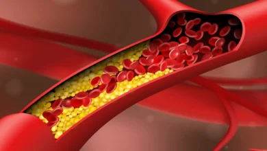 كيفية منع انسداد الشرايين