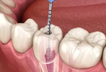 root canal filling