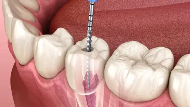 root canal filling