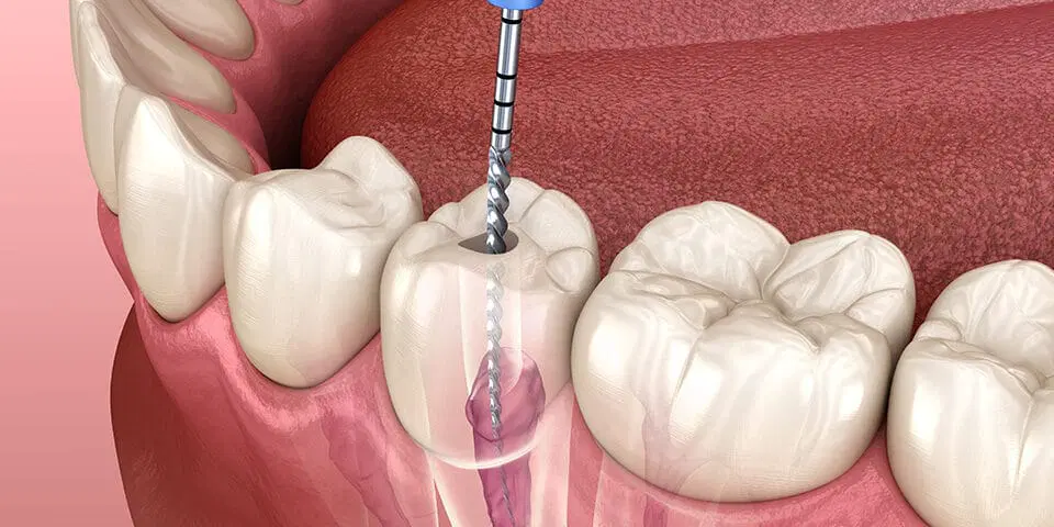 root canal filling